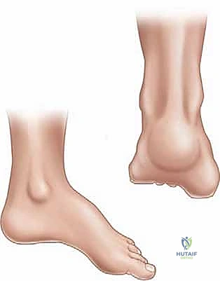 تحرير الأنسجة الرخوة في جراحة القدم