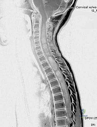 التأهيل الطبيعي بعد جراحة القدم