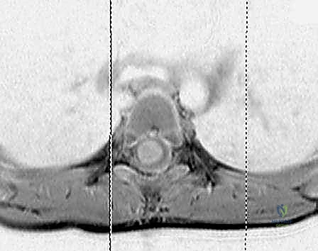 جراحة القدم الجوفاء عند الأطفال: دليل شامل للعلاج والتعافي مع الأستاذ الدكتور محمد هطيف