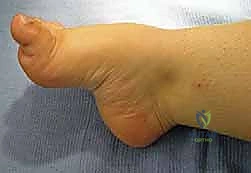 تأثير الوراثة على تشوهات القدم