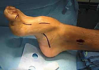 التشخيص السريري للقدم الجوفاء