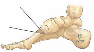 أعراض القدم الجوفاء وتكون مسامير اللحم