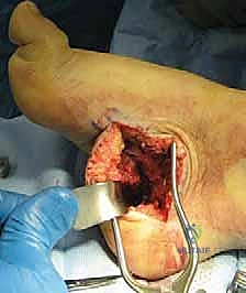 تثبيت المفاصل في الحالات المتقدمة