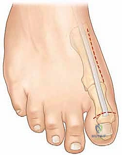 العلاج الطبيعي للقدم الجوفاء