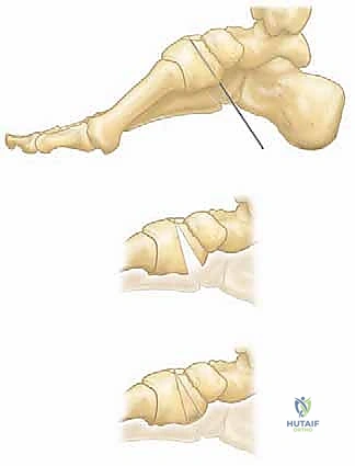 قطع العظم التصحيحي للقدم الجوفاء