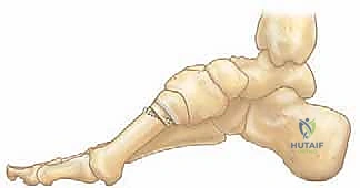 التحضير لعملية القدم الجوفاء