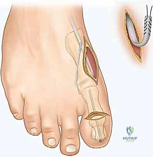 صورة توضيحية لـ جراحة القدم الجوفاء عند الأطفال: دليل شامل للعلاج والتعافي مع الأستاذ الدكتور محمد هطيف