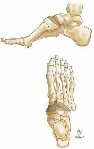صورة توضيحية لـ جراحة القدم الجوفاء عند الأطفال: دليل شامل للعلاج والتعافي مع الأستاذ الدكتور محمد هطيف