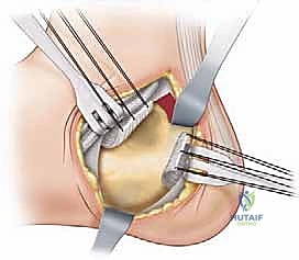 صورة توضيحية لـ جراحة القدم الجوفاء عند الأطفال: دليل شامل للعلاج والتعافي مع الأستاذ الدكتور محمد هطيف