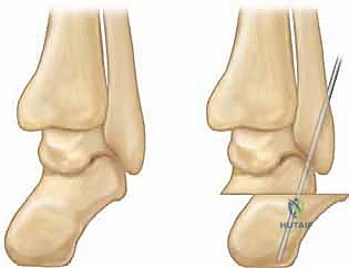 صورة توضيحية لـ جراحة القدم الجوفاء عند الأطفال: دليل شامل للعلاج والتعافي مع الأستاذ الدكتور محمد هطيف