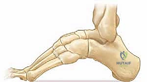 خطوات العملية الجراحية لتصحيح القدم