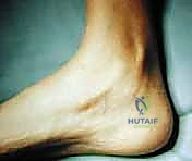 صورة توضيحية لـ جراحة القدم الجوفاء عند الأطفال: دليل شامل للعلاج والتعافي مع الأستاذ الدكتور محمد هطيف