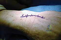 Illustration of previously described technique - Dr. Mohammed Hutaif
