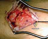 صورة توضيحية لـ تثبيت مفصل الرسغ الجزئي: حلول متقدمة لتخفيف الألم والحفاظ على الحركة مع الأستاذ الدكتور محمد هطيف