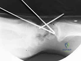 صورة توضيحية لـ تثبيت مفصل الرسغ الجزئي: حلول متقدمة لتخفيف الألم والحفاظ على الحركة مع الأستاذ الدكتور محمد هطيف