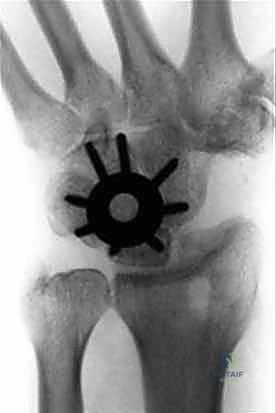 صورة توضيحية لـ تثبيت مفصل الرسغ الجزئي: حلول متقدمة لتخفيف الألم والحفاظ على الحركة مع الأستاذ الدكتور محمد هطيف