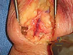 تثبيت مفصل الرسغ الجزئي: حلول متقدمة لتخفيف الألم والحفاظ على الحركة مع الأستاذ الدكتور محمد هطيف