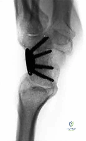 عملية دمج الزوايا الأربع في الرسغ Four-Corner Fusion