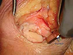 الانهيار المتقدم للرسغ SLAC و SNAC