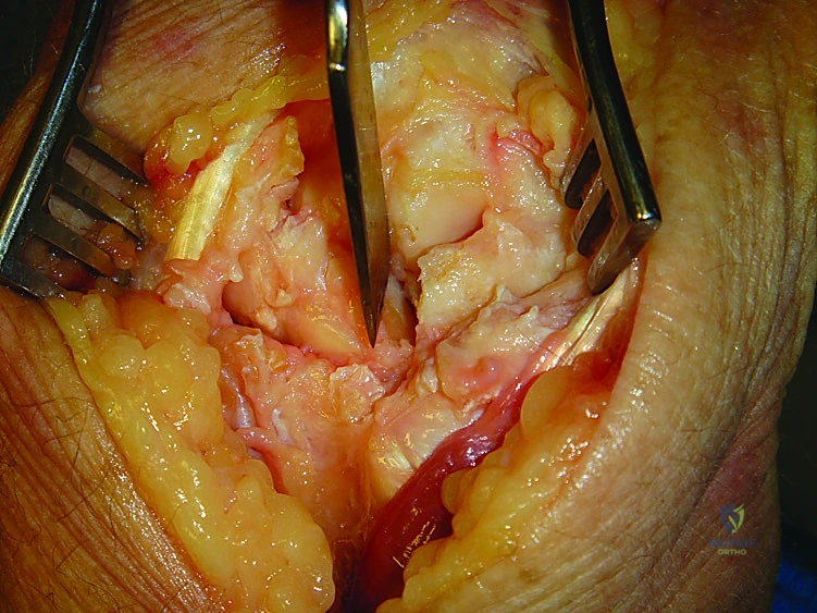 صورة توضيحية لـ تثبيت مفصل الرسغ الجزئي: حلول متقدمة لتخفيف الألم والحفاظ على الحركة مع الأستاذ الدكتور محمد هطيف