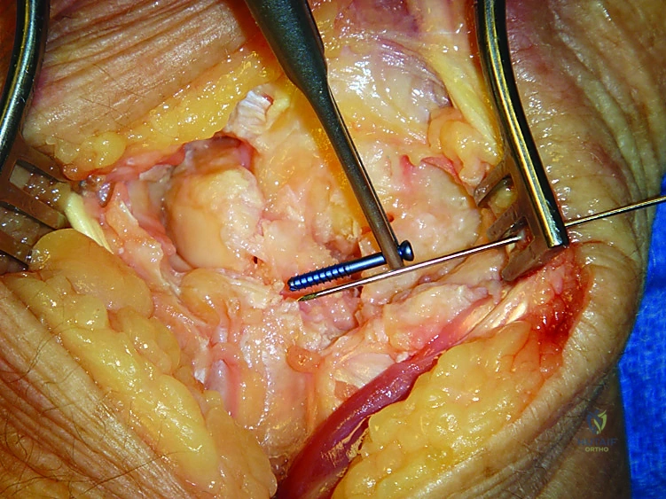 التشريح المعقد لمفصل الرسغ وعظامه الثمانية