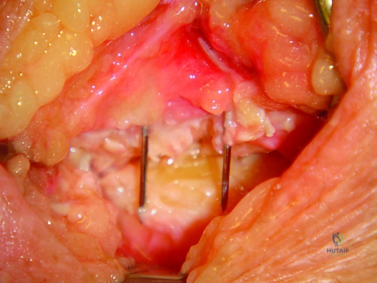 الشق الجراحي والوصول إلى عظام الرسغ