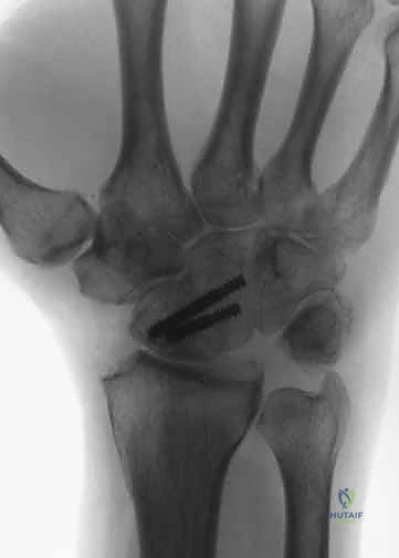 صورة توضيحية لـ تثبيت مفصل الرسغ الجزئي: حلول متقدمة لتخفيف الألم والحفاظ على الحركة مع الأستاذ الدكتور محمد هطيف