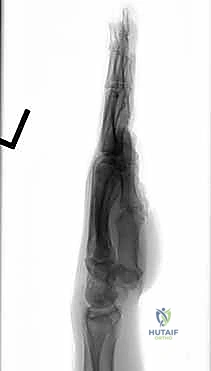 Illustration of previously described technique - Dr. Mohammed Hutaif