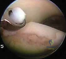 Ankle Arthroscopy & Microfracture for Osteochondral Lesions of the Talus: A Masterclass