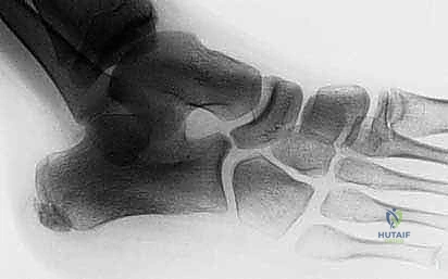 الالتصاق العظمي بين العقب والعظم الزورقي فهم شامل وعلاج دقيق للقدم المسطحة الصلبة مع الأستاذ الدكتور محمد هطيف