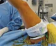 التشخيص الإشعاعي للالتصاق العظمي بين العقب والزورقي