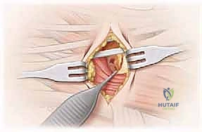 أعراض القدم المسطحة الصلبة والألم المصاحب للالتصاق