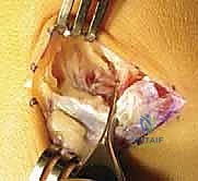 استخدام الأشعة المقطعية لتحديد حجم الالتصاق بدقة