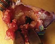 استئصال العظم الزائد واستعادة مساحة المفصل