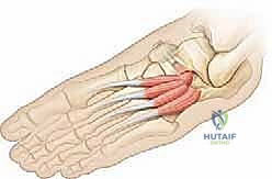 صورة توضيحية لـ الالتصاق العظمي بين العقب والعظم الزورقي فهم شامل وعلاج دقيق للقدم المسطحة الصلبة مع الأستاذ الدكتور محمد هطيف