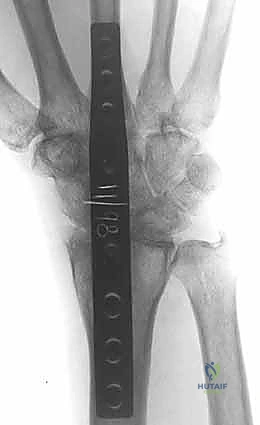 خطوات إزالة الغضاريف وتحضير الأسطح العظمية للدمج