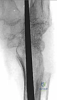 تثبيت مفصل الرسغ الكلي: دليل شامل لعلاج التهاب الرسغ المزمن في صنعاء مع الأستاذ الدكتور محمد هطيف