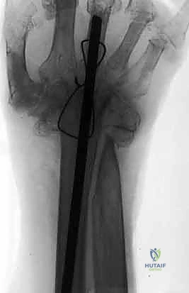 تثبيت الرسغ باستخدام شريحة التيتانيوم والمسامير الخاصة