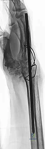 Illustration of complete wrist arthrodesis - Dr. Mohammed Hutaif