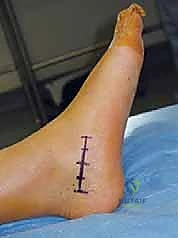 جراحة إزالة ائتلاف الكاحل العقبي ورأب المفصل بالترقيع دليل شامل للمرضى مع الأستاذ الدكتور محمد هطيف