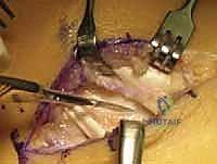 Illustration of excision of talocalcaneal - Dr. Mohammed Hutaif