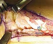 ائتلاف الكاحل العقبي وتأثيره على القدم