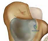 صورة توضيحية للتشريح العظمي للكاحل الخلفي، وتحديدًا للناتئ الخلفي لعظم الكاحل والعظم المثلثي.