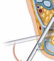 صورة توضيحية لـ متلازمة انحشار الكاحل الخلفي: دليلك الشامل للتشخيص والعلاج مع الأستاذ الدكتور محمد هطيف