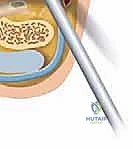 التحضير الجراحي وتحديد المعالم التشريحية قبل تنظير الكاحل