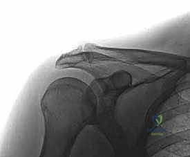 صورة توضيحية لـ استئصال الجزء البعيد من الترقوة بالمنظار: حل دائم لآلام مفصل الكتف المزمنة في صنعاء