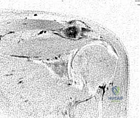 صورة توضيحية لـ التشريح الدقيق لمفصل الكتف