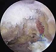 صورة توضيحية لـ استئصال الجزء البعيد من الترقوة بالمنظار: حل دائم لآلام مفصل الكتف المزمنة في صنعاء