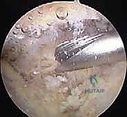 صورة توضيحية لـ الإجراء الجراحي