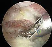 استئصال الجزء البعيد من الترقوة بالمنظار: حل دائم لآلام مفصل الكتف المزمنة في صنعاء